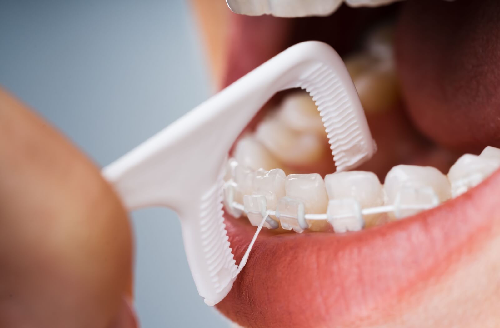 Close-up of a person using a floss pick to gently clean between their braces before brushing their teeth at the end of the day.