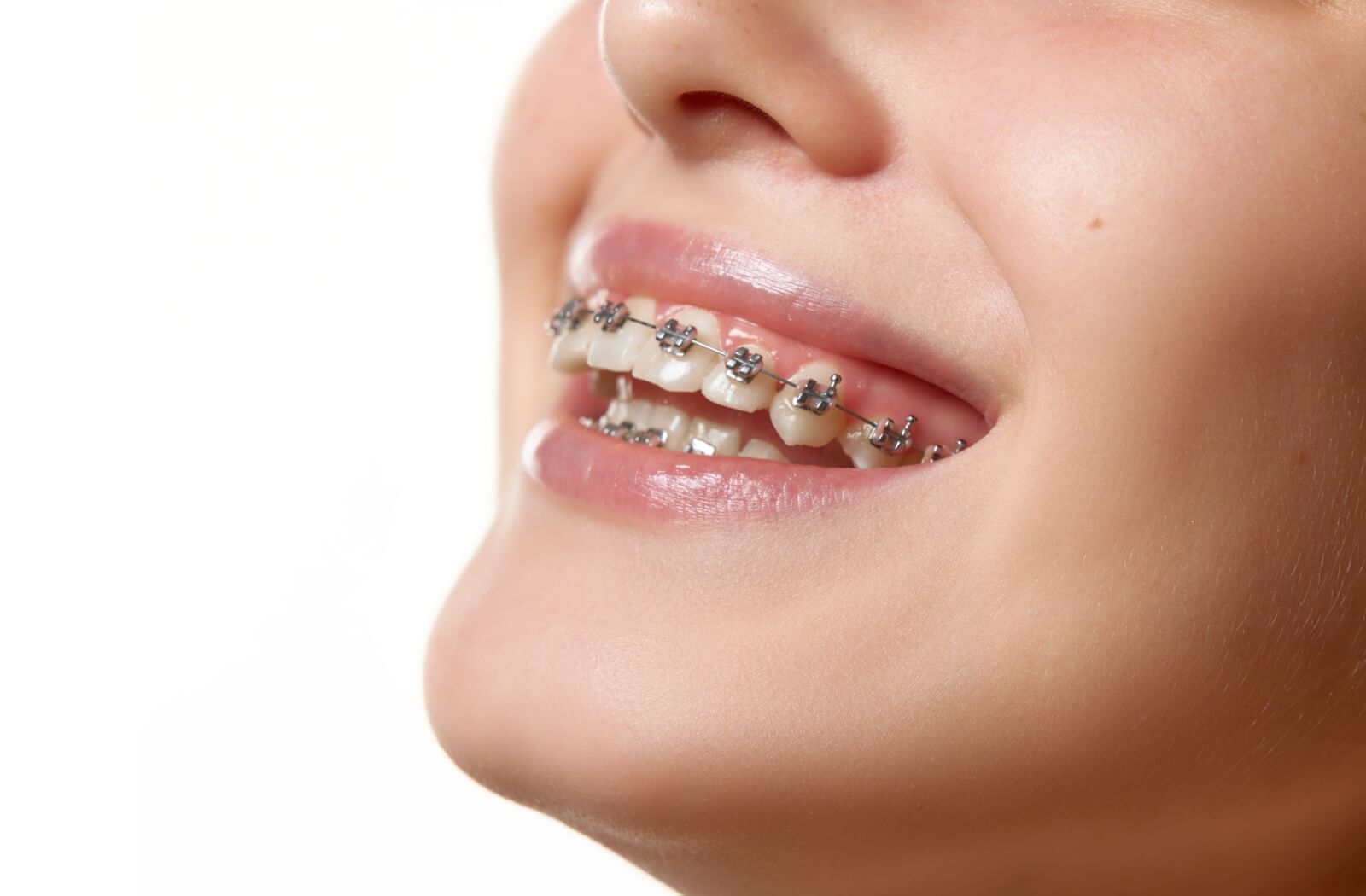 Close-up of a smiling person wearing metal braces on their teeth, showing the mouth and lower face.